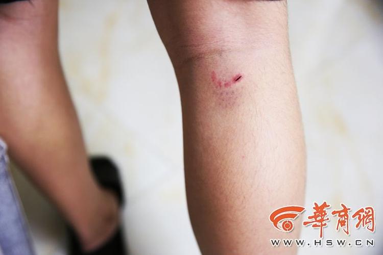 西安14岁男孩小区内被狗咬伤狗主人留空号离开 公安部门将介入调查