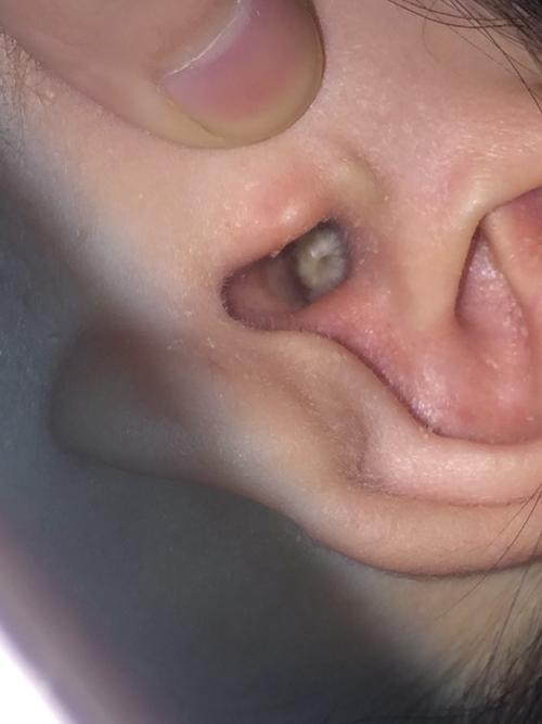 每年耳朵都流水流脓 谁知道耳朵里面是什么可以挖掉吗