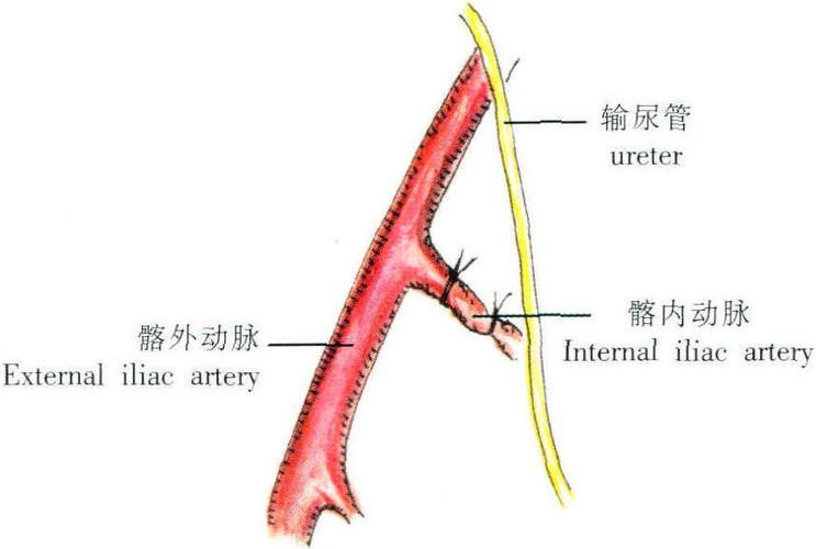 结清扫术),否则进入腹腔,于骨盆漏斗韧带外侧,可触摸到髂血管及输尿管