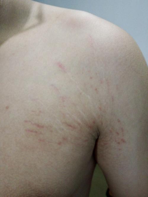 因为练俯卧撑,胳肢窝附近有一些像妊辰纹一样的东西求