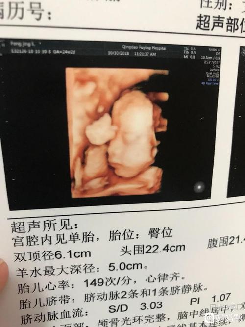 今天做了四维彩超双肾未见明显分离有的妈妈帮里面说是男宝还是女宝