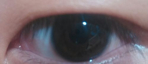 眼睛泪阜那是不是长了什么东西,还是什么,泪阜不是就那一点的吗,怎么