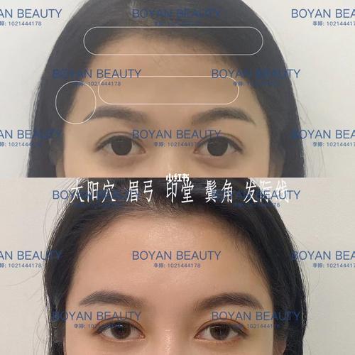 原先的眼睛显得有点"金鱼眼" 很多人这种情况的时候 就直接想做眼睛