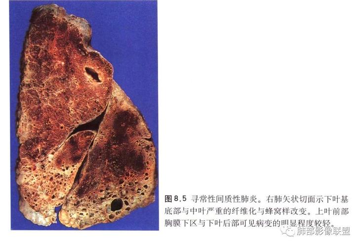 特发性间质性肺炎病理,影像及临床解析——丁啸