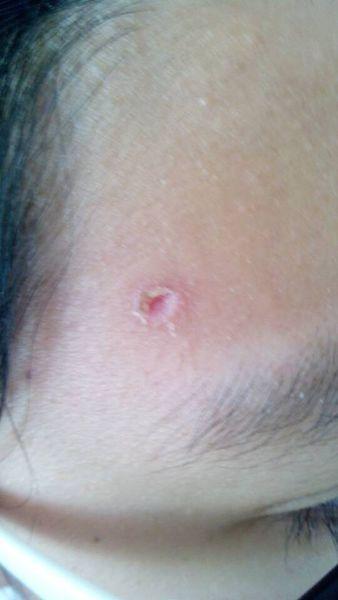 我起水痘了,现在已经是第12天了,但是伤口已经结痂很多天了.