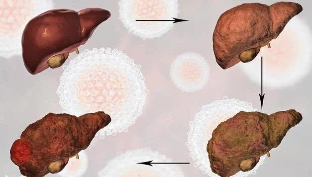 第一类:肝炎患者