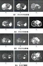 磁共振(mr) 弥散加权(dm) 成像与常规核磁共振成像 (mri) 不同 ,它的