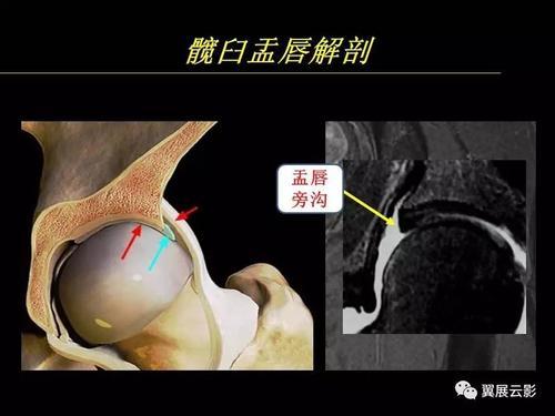 专家课堂课后整理髋关节撞击综合征和盂唇损伤的mr诊断