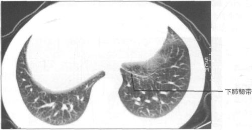三,胸部正常ct解剖