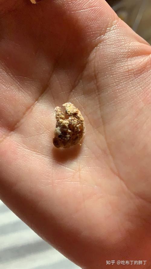 疫情期火疖子感染自行处理治愈过程