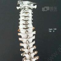 男14岁,先天性脊柱侧后凸