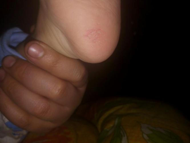 我儿子是2013/8/14出生,今天晚上发现我家宝宝脚后跟起皮是怎么回事!