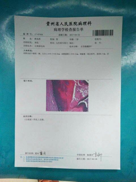 告诉我活检结果皮下囊肿. 告诉我活检结果皮下囊肿