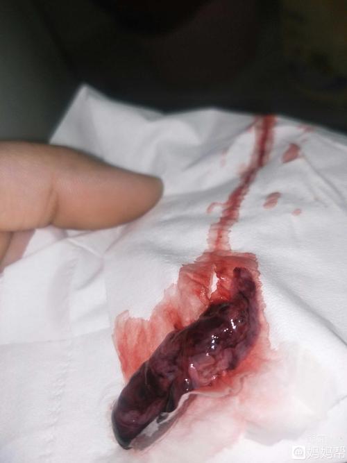 图三是上午十一点流出来的,b超看不见孕囊,是自然流产了吗?