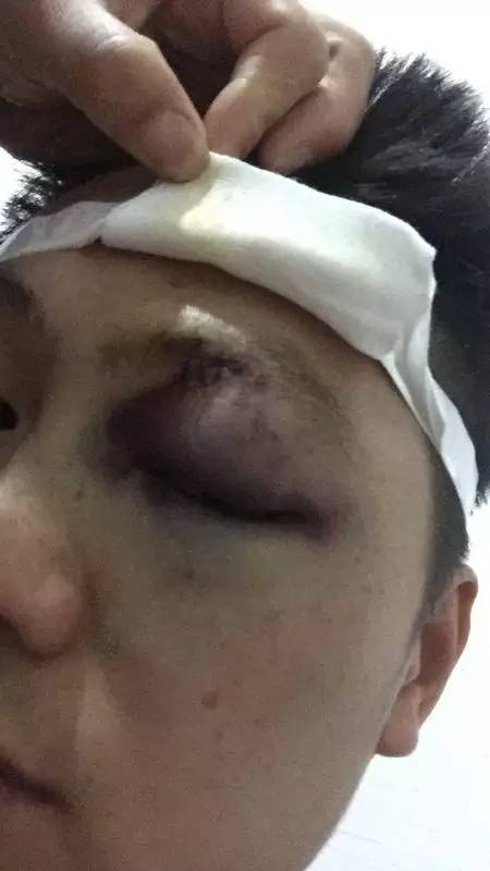 桥头男子在欧秀唱歌出事了,眼睛摔成青肿.