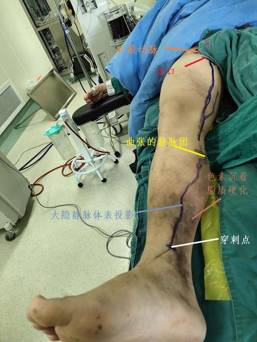 不全的大隐静脉曲张, 3,下肢深静脉功能不全重建后,二期做浅静脉手术