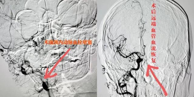 彭州市首例颈内动脉取栓让他转危为安