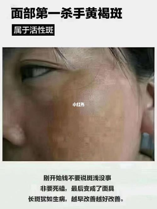 96黄褐斑 为什么我一生气,斑就加重了71 答:中医讲,气滞血瘀.