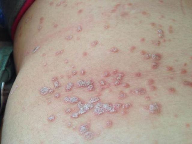 什么是玫瑰糠疹,玫瑰糠疹要如何治疗?|皮疹|皮肤病