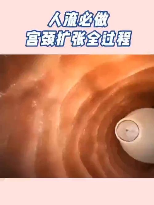 人流必做:宫颈扩张全过程你有见过吗?_医疗健康_医疗