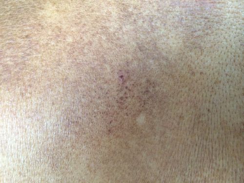 有朋友介绍的人说我这是黑癫疯,会蔓延全身,还说这叫疤痕性皮炎