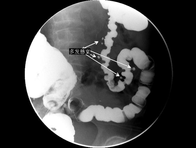 结肠多发憩室1.jpg