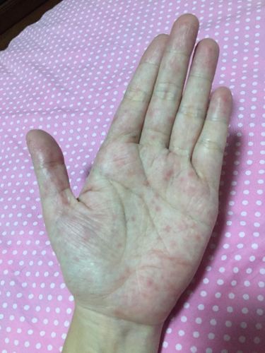 喝酒后手心有红点,为什么?