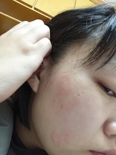 求姐妹看看我脸上长的是藓吗