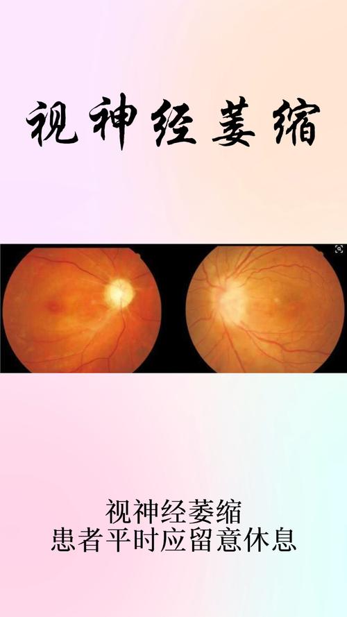破壳计划视神经萎缩患者平时应注意