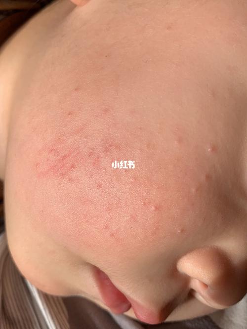 宝宝脸上长的痘痘_痘痘_母婴_育儿经验