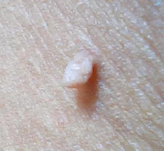 医生公开:别小看皮肤瘙痒,或是hpv到来,有这些肉球,速去检查