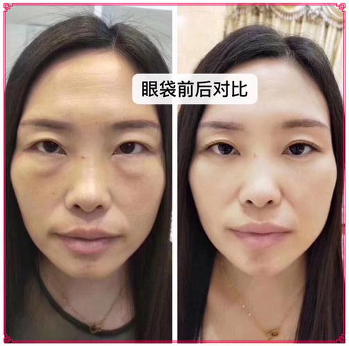 怎么做能缩短眼袋手术后的恢复期?