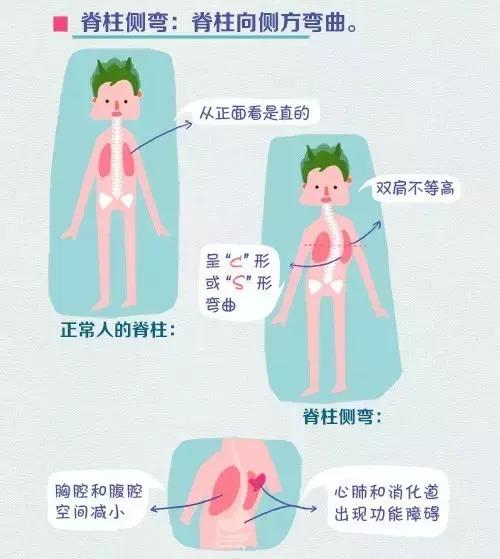 每50人就有1个脊柱侧弯青少年儿童,身高管理师教你规避的方法