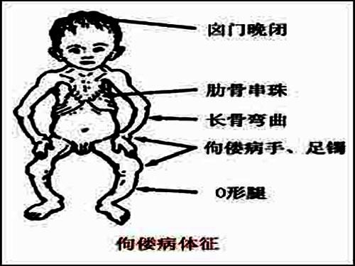 佝偻病手镯简笔画