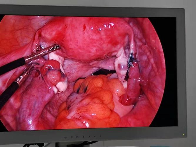 输卵管吻合复通术——不孕和输卵管结扎女性的福音