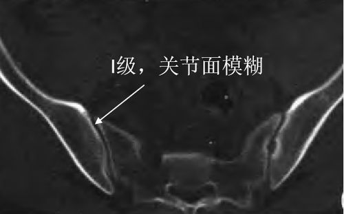 【强直性脊柱炎】骶髂关节炎,级别越高,强直越重?