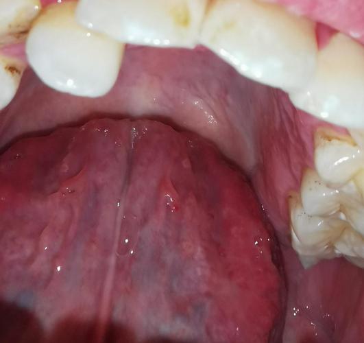 病情描述: 与hpv患者接吻过,无法确定她口腔是否有,看自己口腔怪怪的