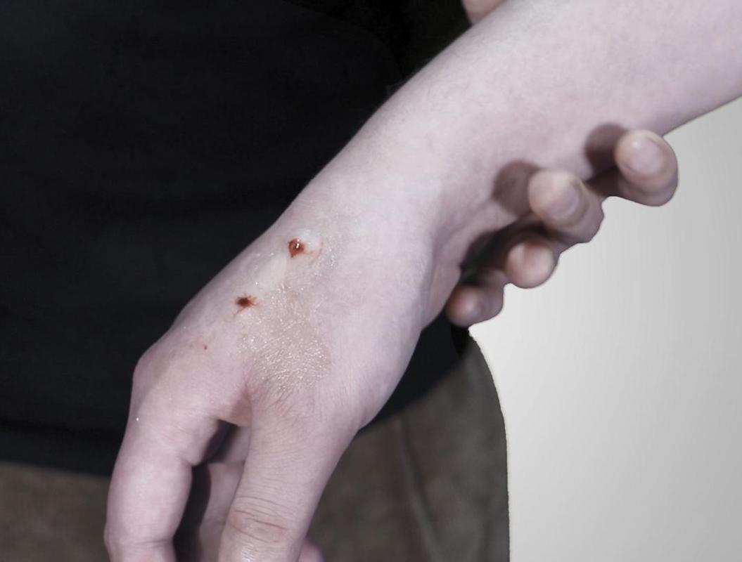 被狗咬伤后的三步处理方法,你知道该怎么做吗?