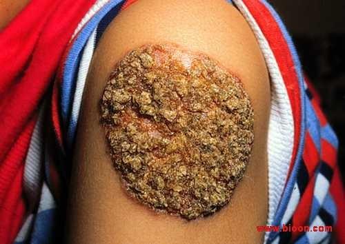 皮肤结核病_360百科