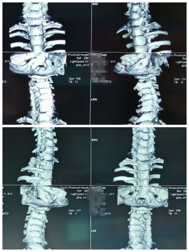 颈椎ct三维重建