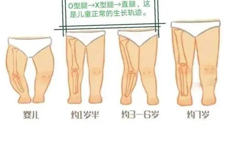 宝贝o型腿,x型腿?不说明缺钙,也不能让纸尿裤背锅
