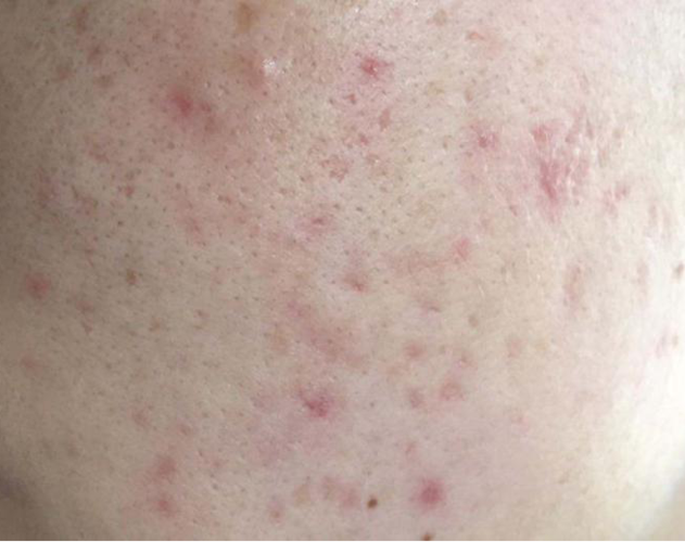 痘印有哪些类型分别如何对症下药