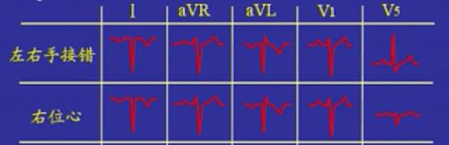 心电图中"左右手接反"和"右位心"的鉴别