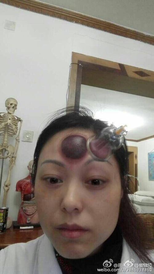 [转载]一人多图(2)——美女脑门拔罐静态全记录