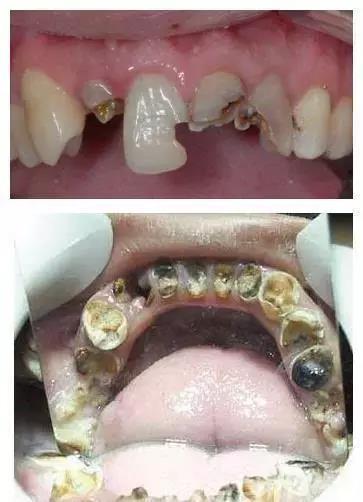 牙齿烂到根本停不下来怎么办?