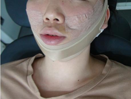 手术后用有弹力的绷带给脸固定了