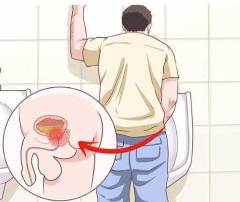 尿频尿急尿不尽是怎么回事?需要治疗吗?