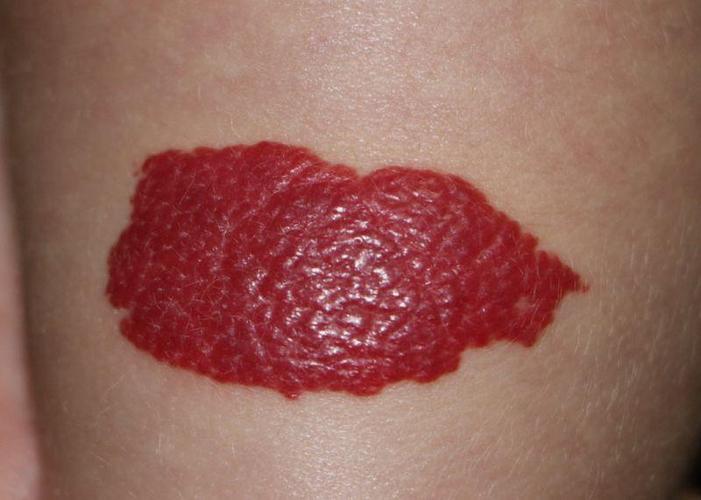 孩子身上这5种胎记千万要注意!