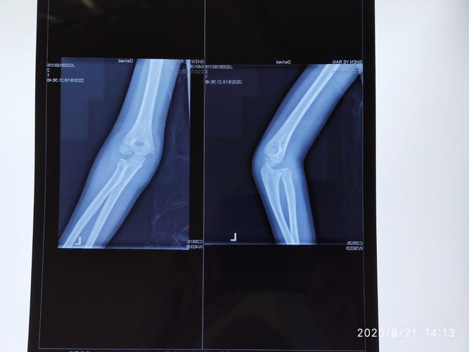 儿童骨折的陷阱:儿童孟氏骨折脱位