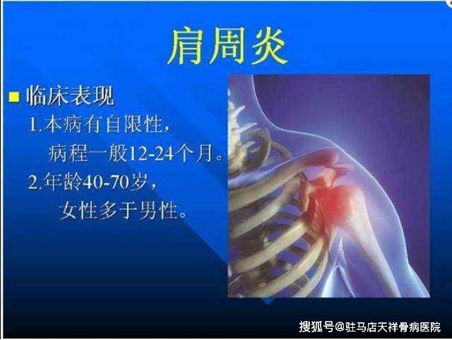 原创肩周炎的早期症状有哪些?怎么预防肩周炎?